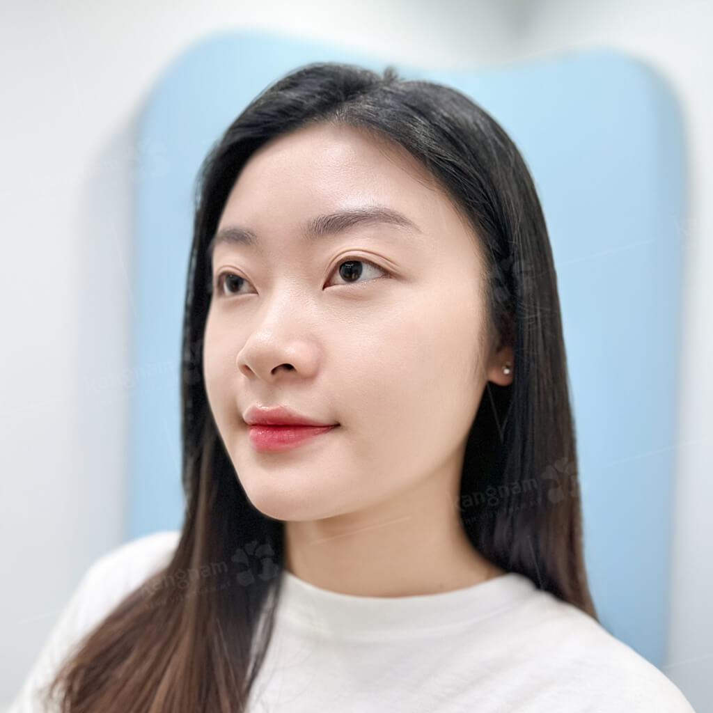 Sau gọt hàm gương mặt nhanh phục hồi và ổn định