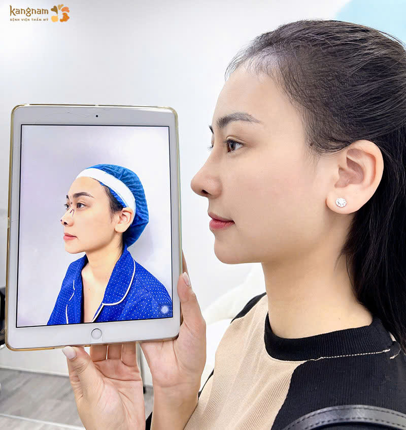 Mũi cao và thẳng sau khi phẫu thuật nâng mũi