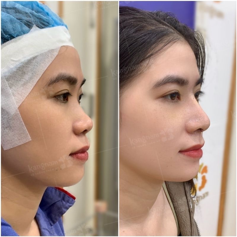 Dáng mũi cá nhân hóa, hài hòa với gương mặt