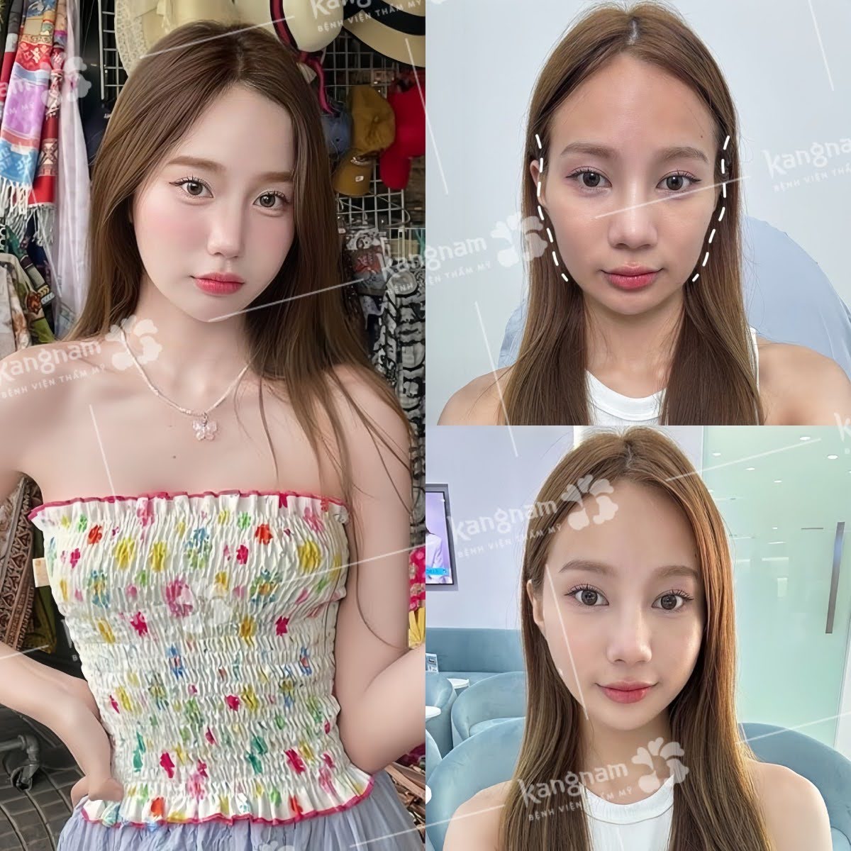 Khuôn mặt cân đối, tươi trẻ do được khắc phục tình trạng hõm, lõm