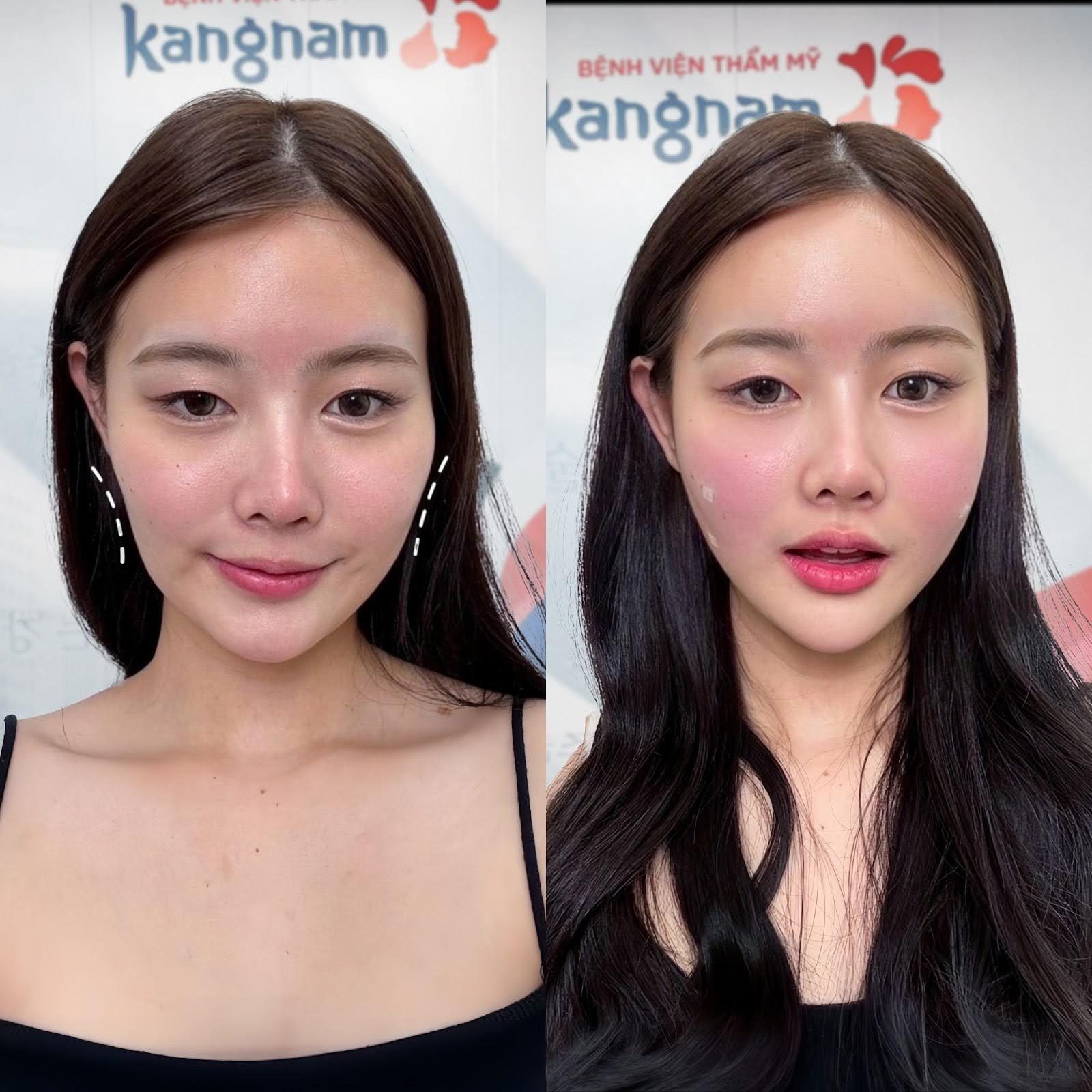 tiêm filler, botox hoặ meso giúp làn da đầy đặn, căng bóng