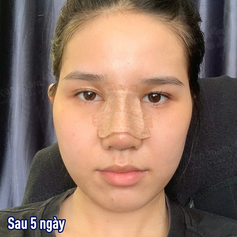 Sau làm mũi vài ngày vết thương sẽ bớt đau và ổn định hơn