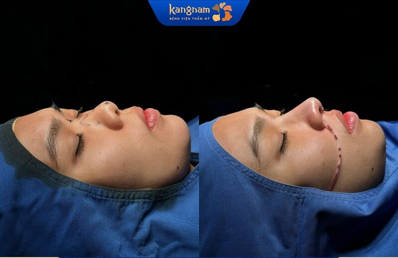 Quá trình làm mũi khách hàng sẽ cảm thấy thoải mái