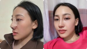 Làm mũi có nguy hiểm không