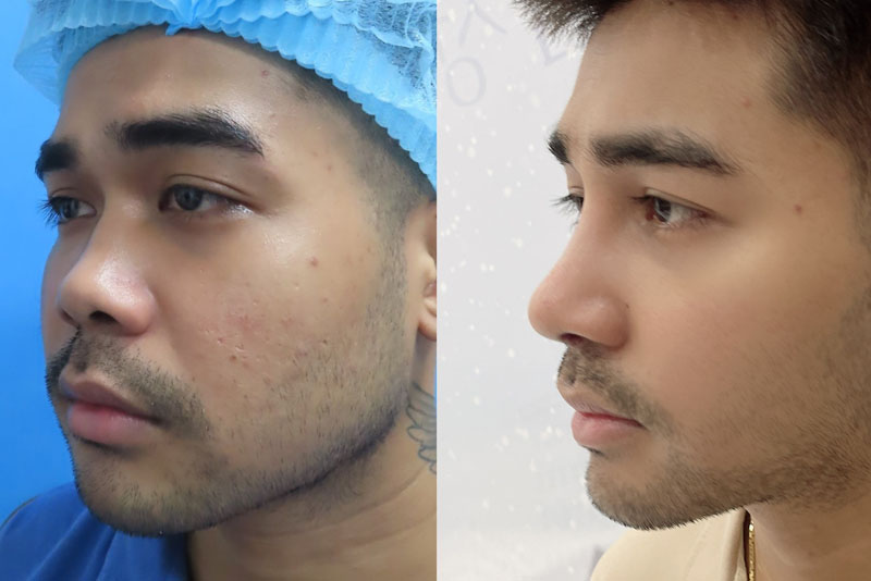 Mũi cao nam tính, tạo góc nghiêng thần thánh