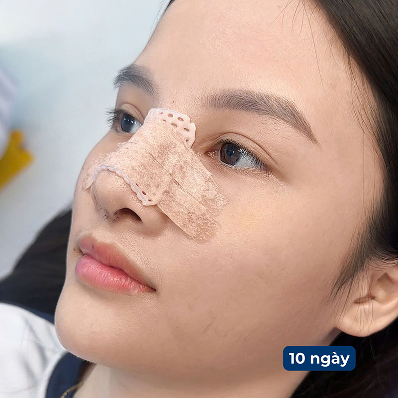 Mũi cần thời gian vào form đẹp