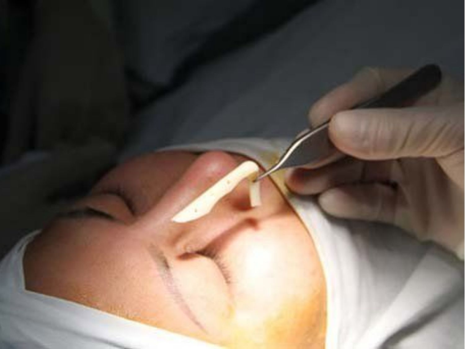 Tháo sụn mũi xong