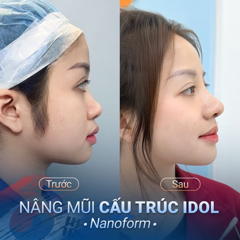 Form mũi tự nhiên, cao vừa phải