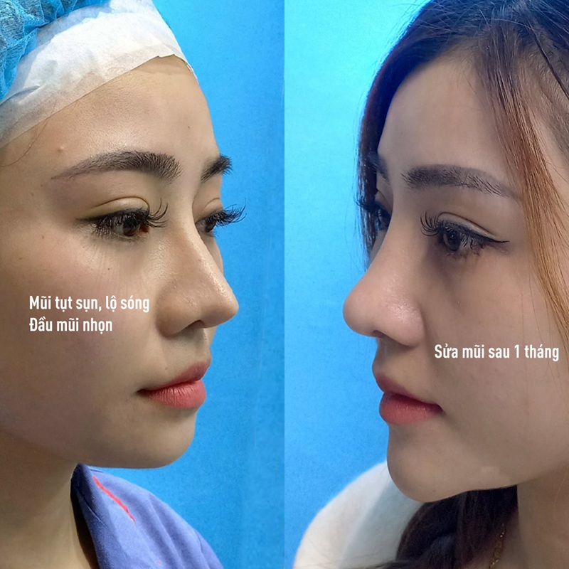 Mũi cao và vào from sau 1 tháng nâng mũi tại Kangnam Hà Nội