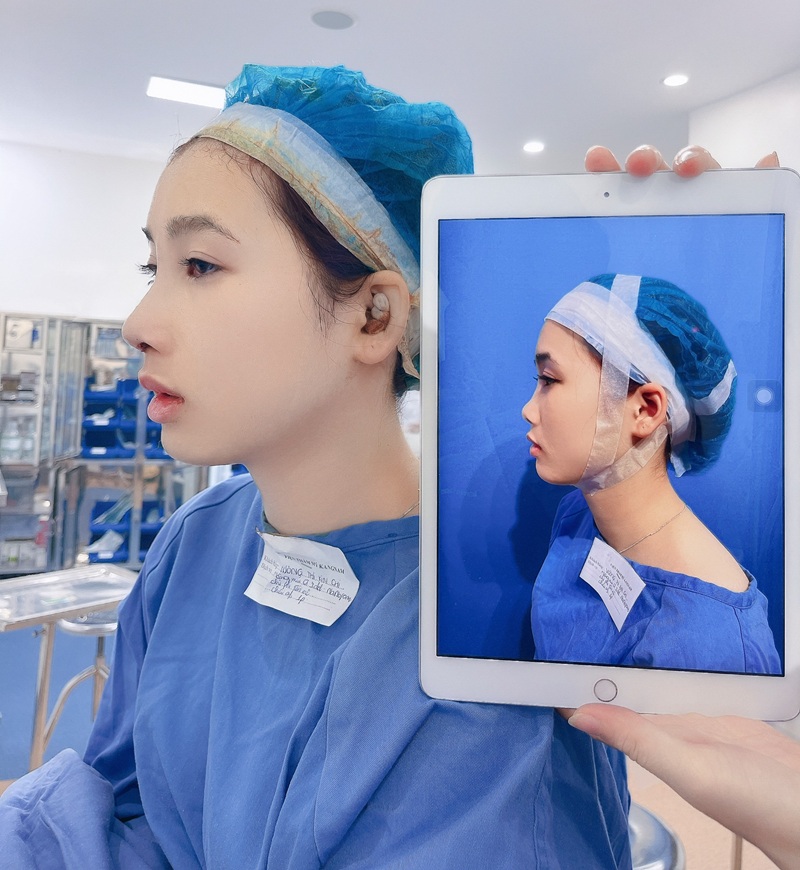 Trước và sau khi mới nâng mũi xong tại Kangnam Hà Nội