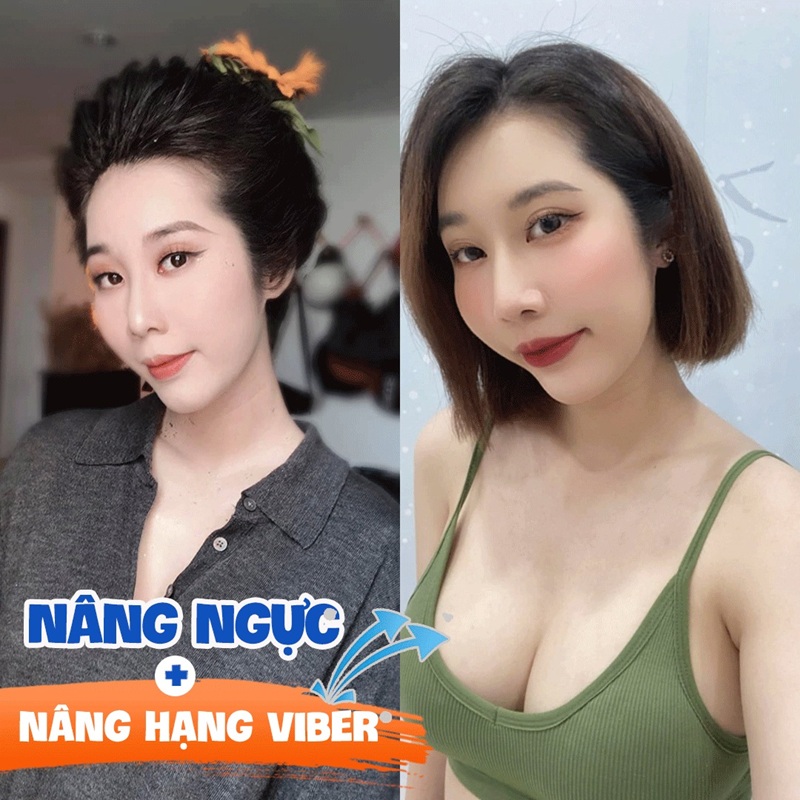 Vòng 1 căng tròn, đầy đặn sau khi nâng ngực