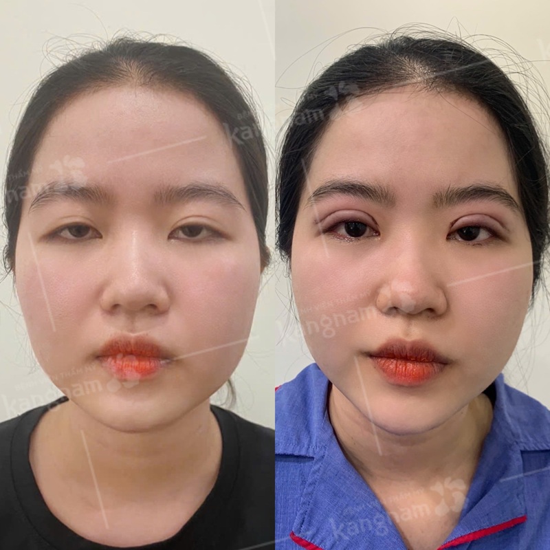 Người có mí sụp nên cắt mí để cải thiện