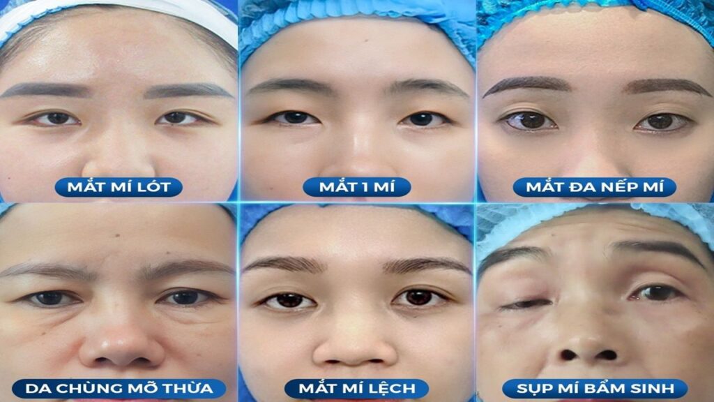 Những ai nên và không nên cắt mí – nhấn mí