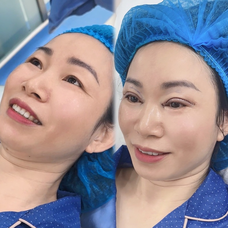 Độ tuổi có ảnh hưởng tới việc nhấn mí hay cắt mí