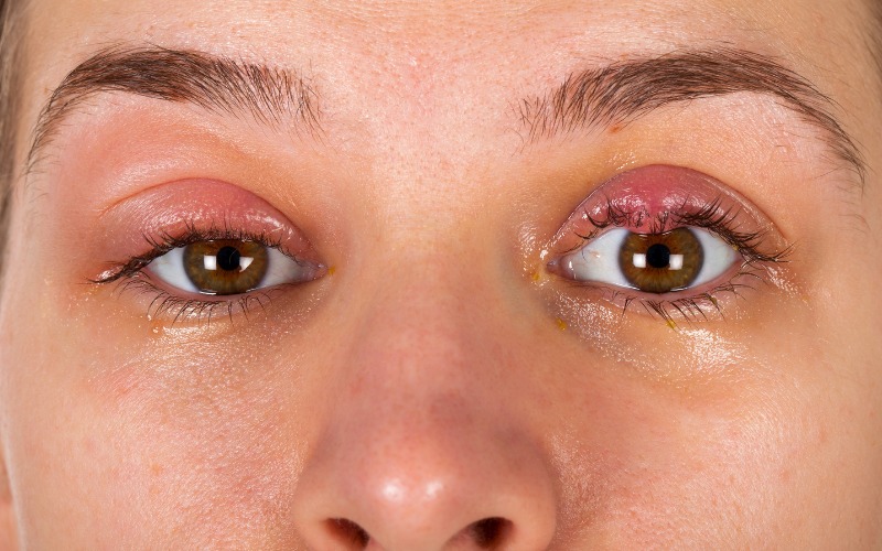 Bị kích ứng da mí gây đau, khó chịu