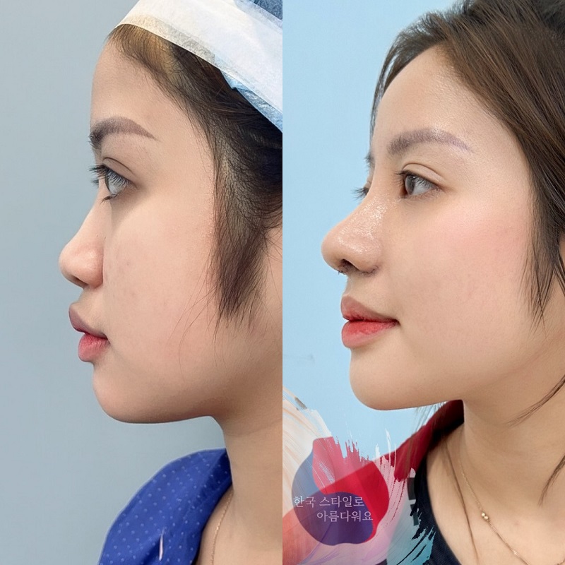 Sinh hoạt đúng cách giúp mũi nhanh phục hồi