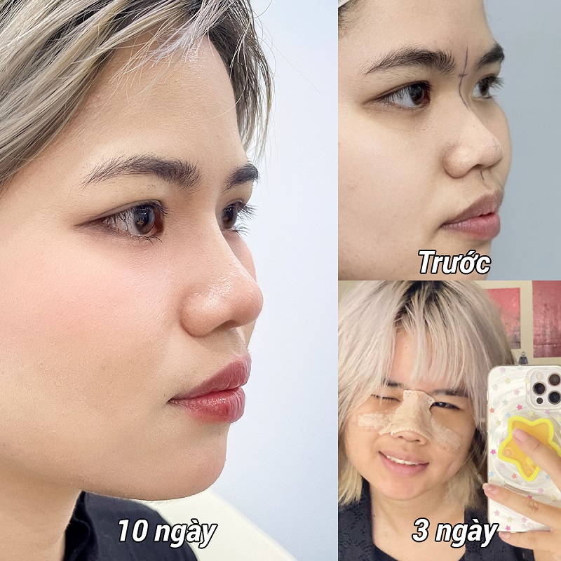 Theo từng mốc thời gian mũi sẽ phục hồi