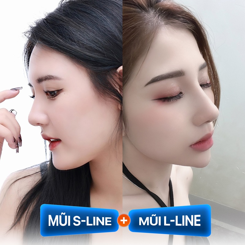 Mũi thẳng S-line sau nâng, bảo hành lâu dài