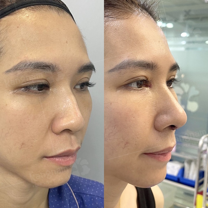 Sử dụng sụn sườn tự thân an toàn, hiệu quả cao