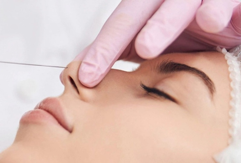 Không cần phẫu thuật sử dụng chỉ sinh học để giúp mũi cao hơn