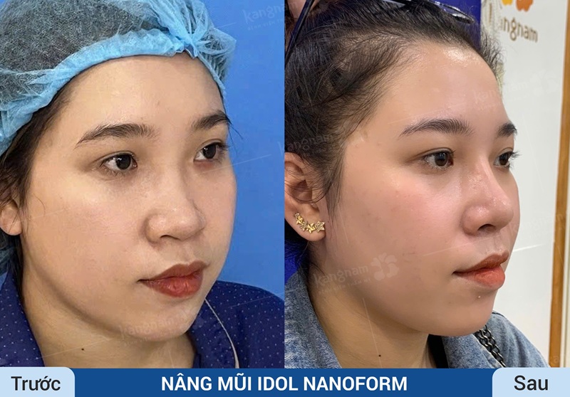 Sử dụng sụn Nanoform nâng an toàn, mũi cao vào đúng form