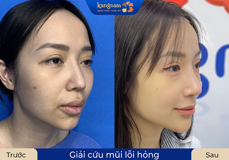 Giải cứu mũi hỏng bằng sụn sườn tự thân