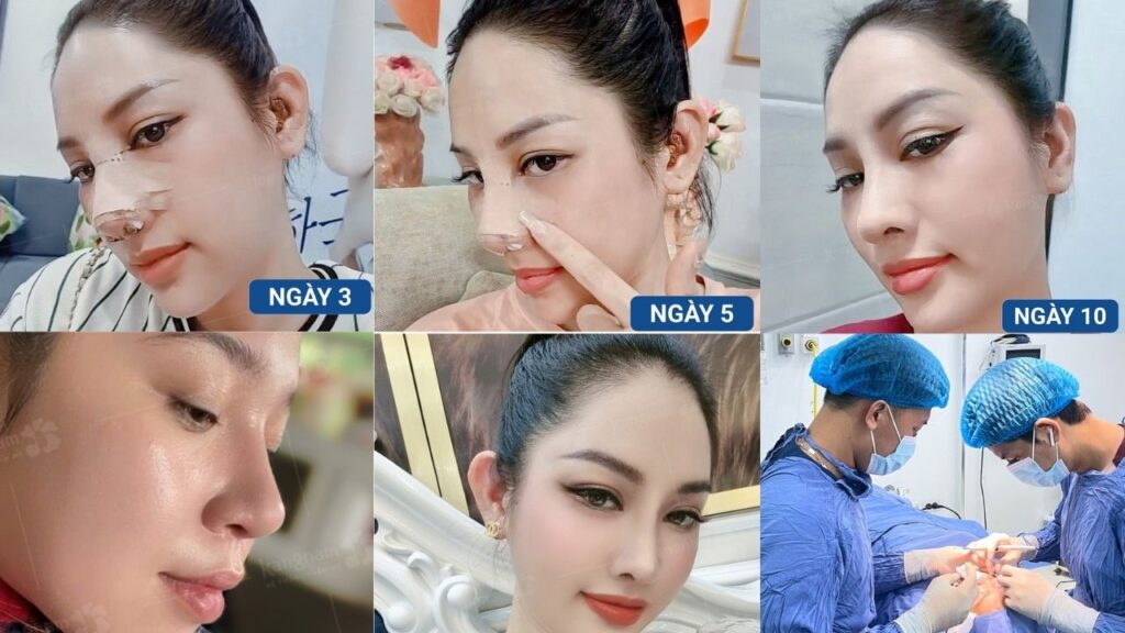 Thời gian hồi phục sau nâng mũi: Bao lâu thì lành và đẹp tự nhiên