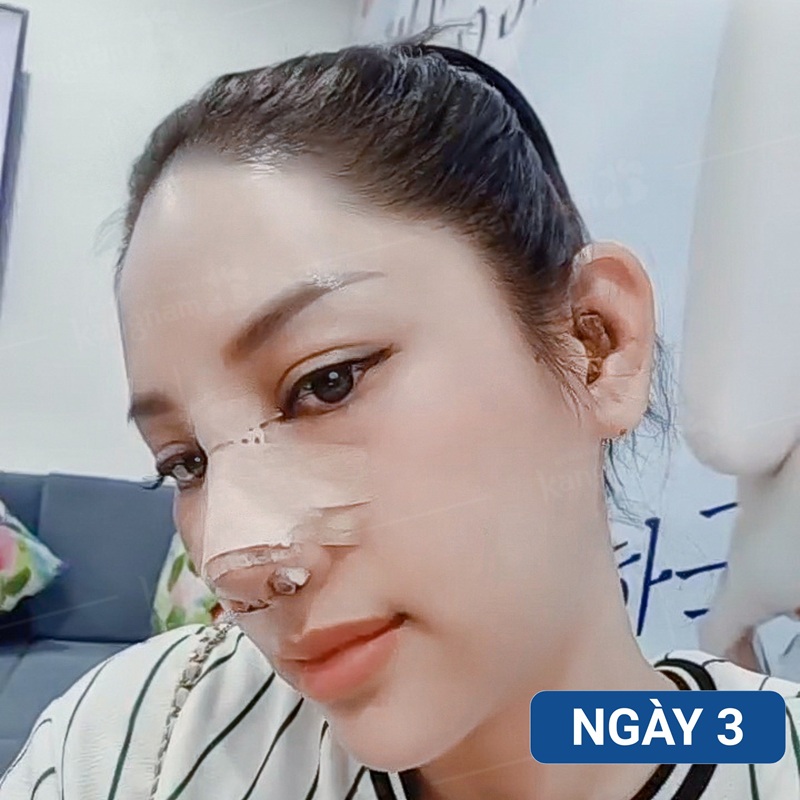 Mũi sưng nhiều nhất