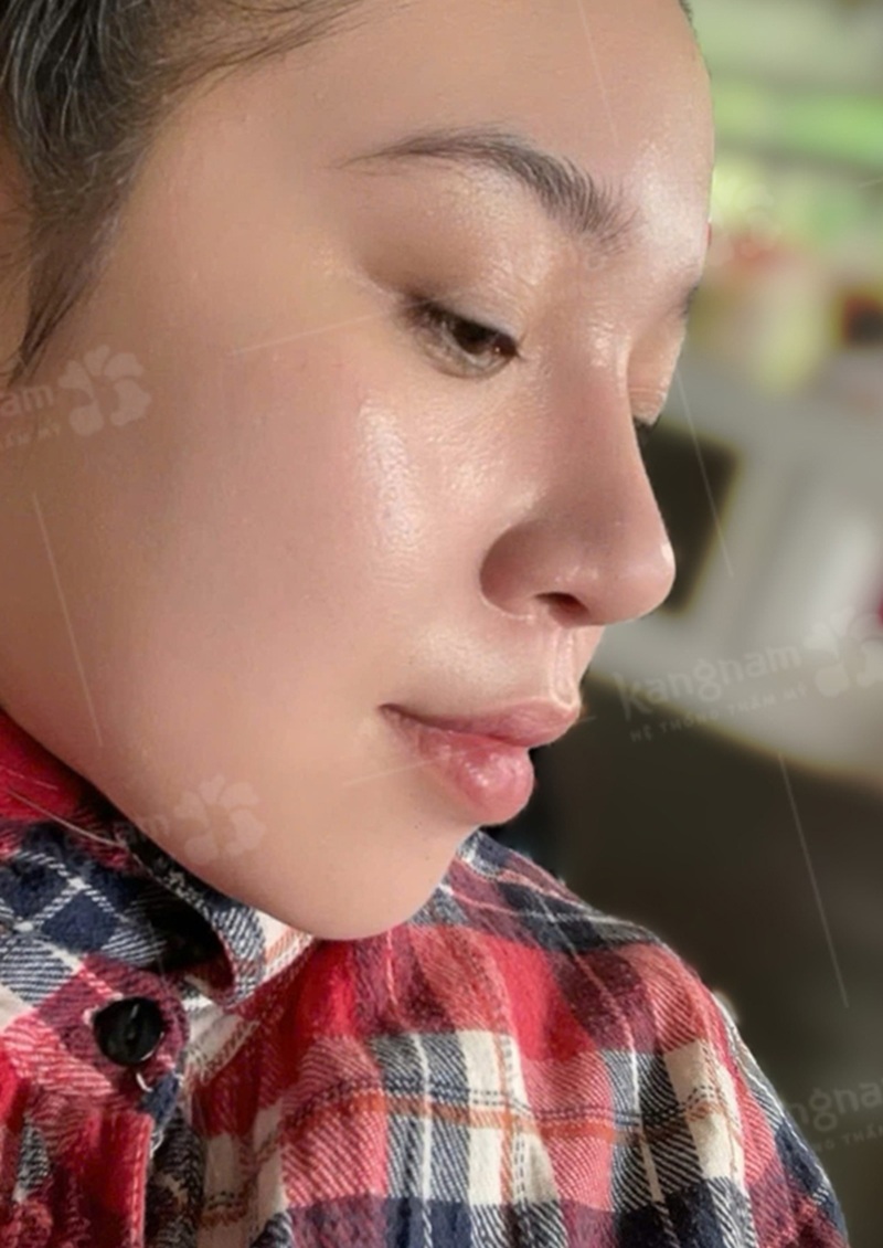 Sau 1 tháng mũi gom lại, bắt đầu vào form 