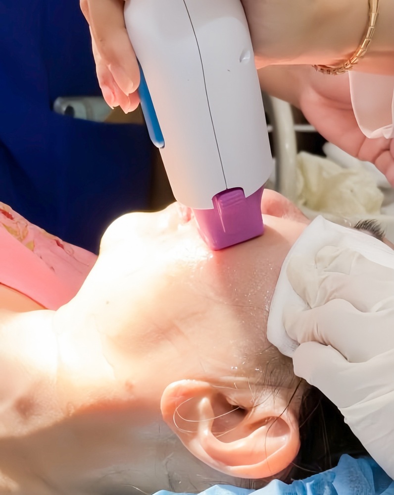 Công nghệ Thermage FLX 