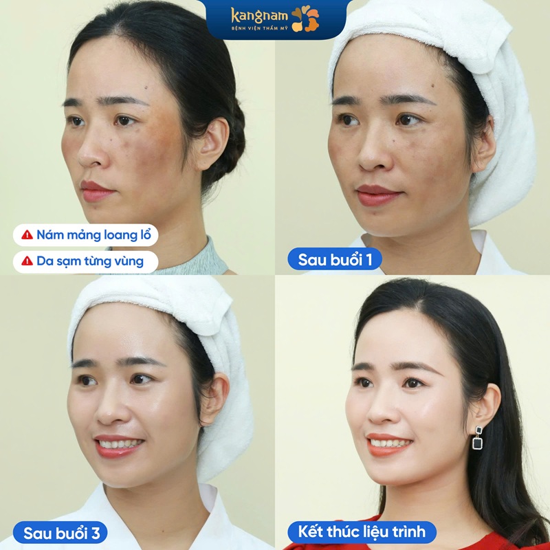 Nám tàn nhang bay sạch sau 1 liệu trình