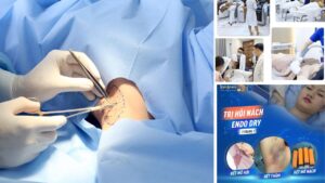 Trị hôi nách tại Kangnam TP.HCM – Giải pháp điều trị an toàn, cải thiện mùi rõ rệt