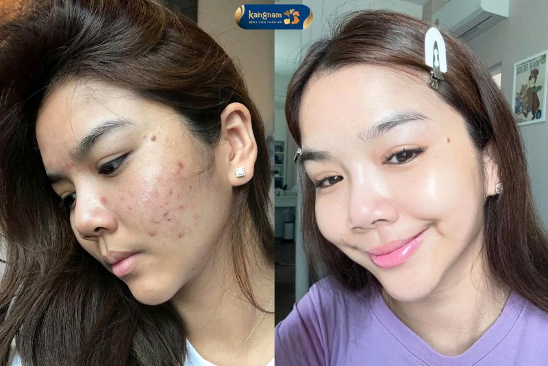 Sạch thâm, sạch mụn, tự tin chụp ảnh camera thường