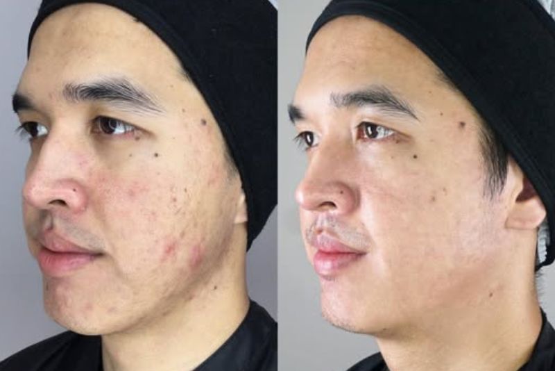 Phác đồ trị mụn cá nhân hóa, an toàn cho da