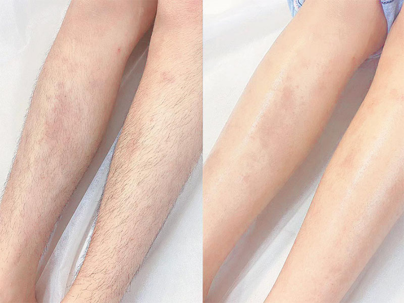 Chân láng mịn, trắng hơn sau khi triệt lông