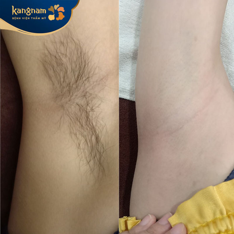 Vùng da nách mịn màng sau khi triệt