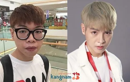 Cách làm mỏng môi 4