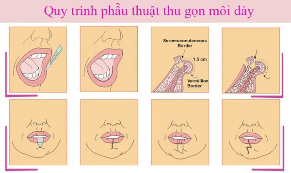 Quy trình làm mỏng môi dày theo các bước