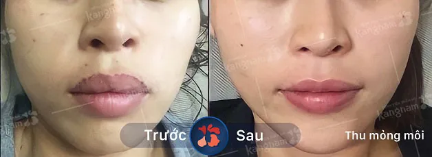 Kết quả trước và sau khi khách hàng thu mỏng môi