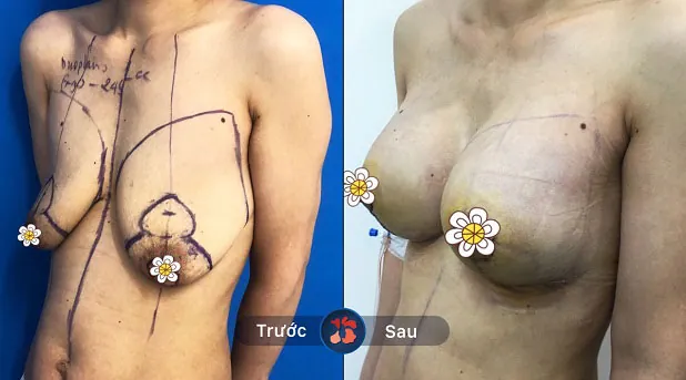 Trước và sau khi khách hàng nâng ngực