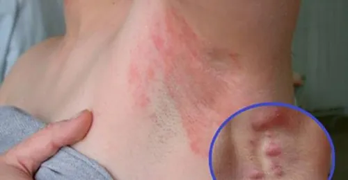 biến chứng trị hôi nách nội soi 