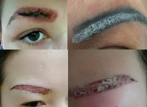 xóa xăm lông mày giá bao nhiêu