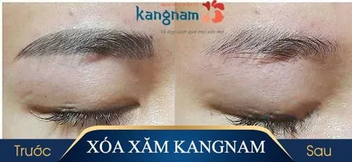 cách xóa xăm lông mày