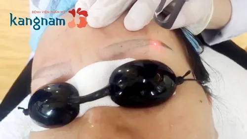 xóa xăm chân mày bằng laser