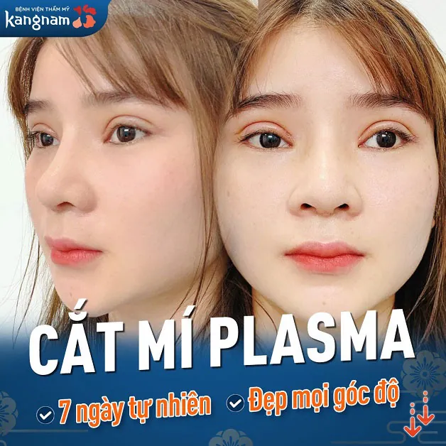 Đẹp tự nhiên sau 7 ngày thực hiện cắt mí mắt