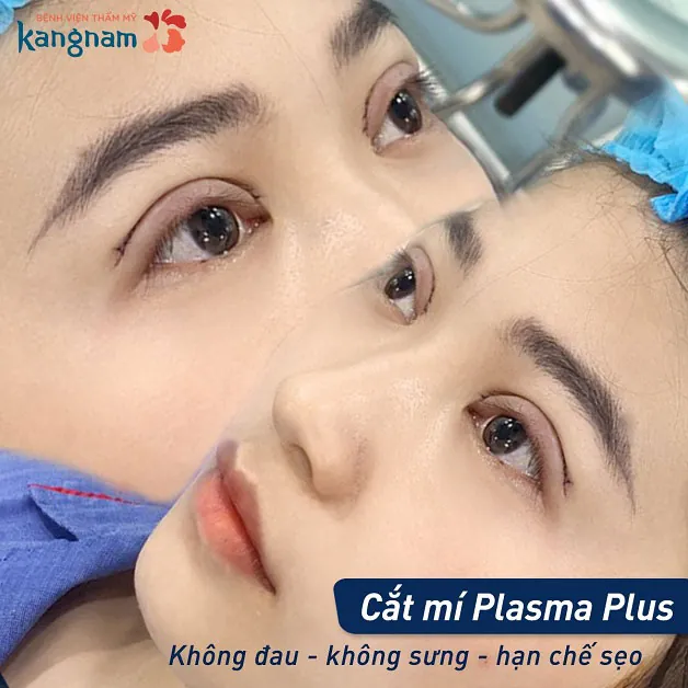 Mí mắt ngay sau khi cắt mí không sưng đau, hạn chế sẹo