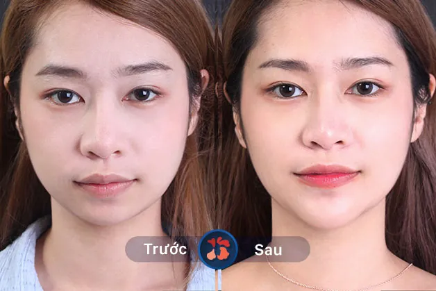 Kết quả trước và sau khi khách hàng độn cằm 