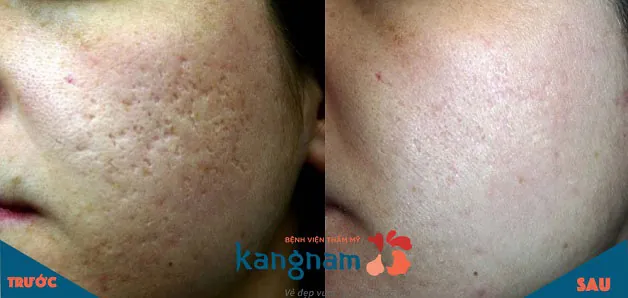 Trả lại làn da mịn màng cho bạn nữ có nhiều sẹo rỗ toàn má