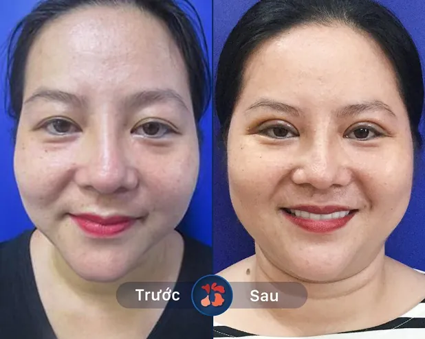 Chỉnh sửa mí mắt không cân xứng, nếp mí cân bằng sau 60 phút