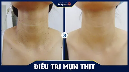 trị mụn thịt ở cổ